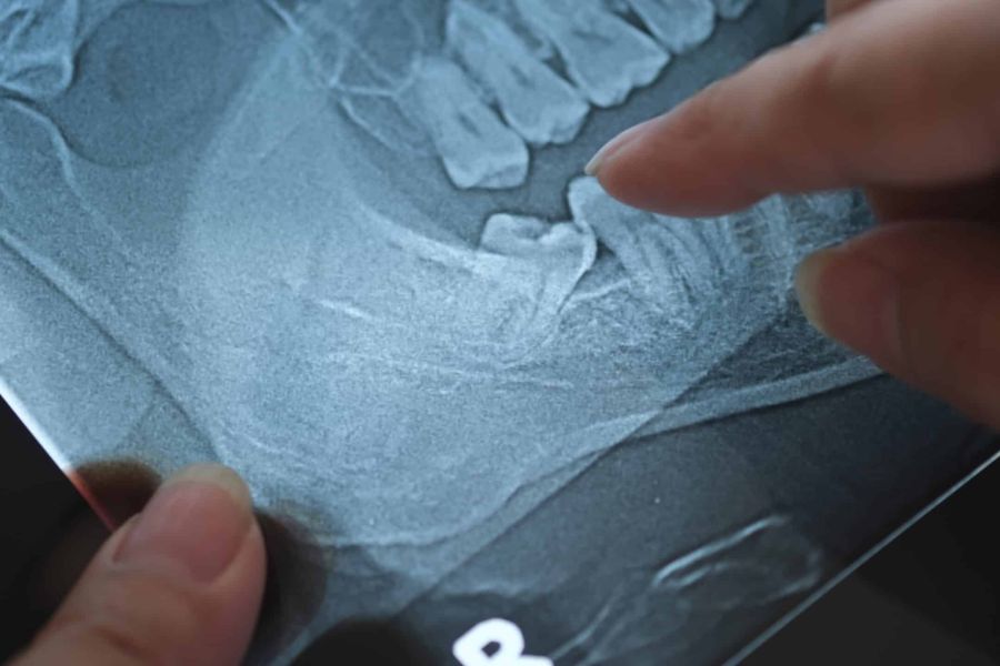 Röntgenbild eines Unterkiefers mit einem schief stehenden Weisheitszahn